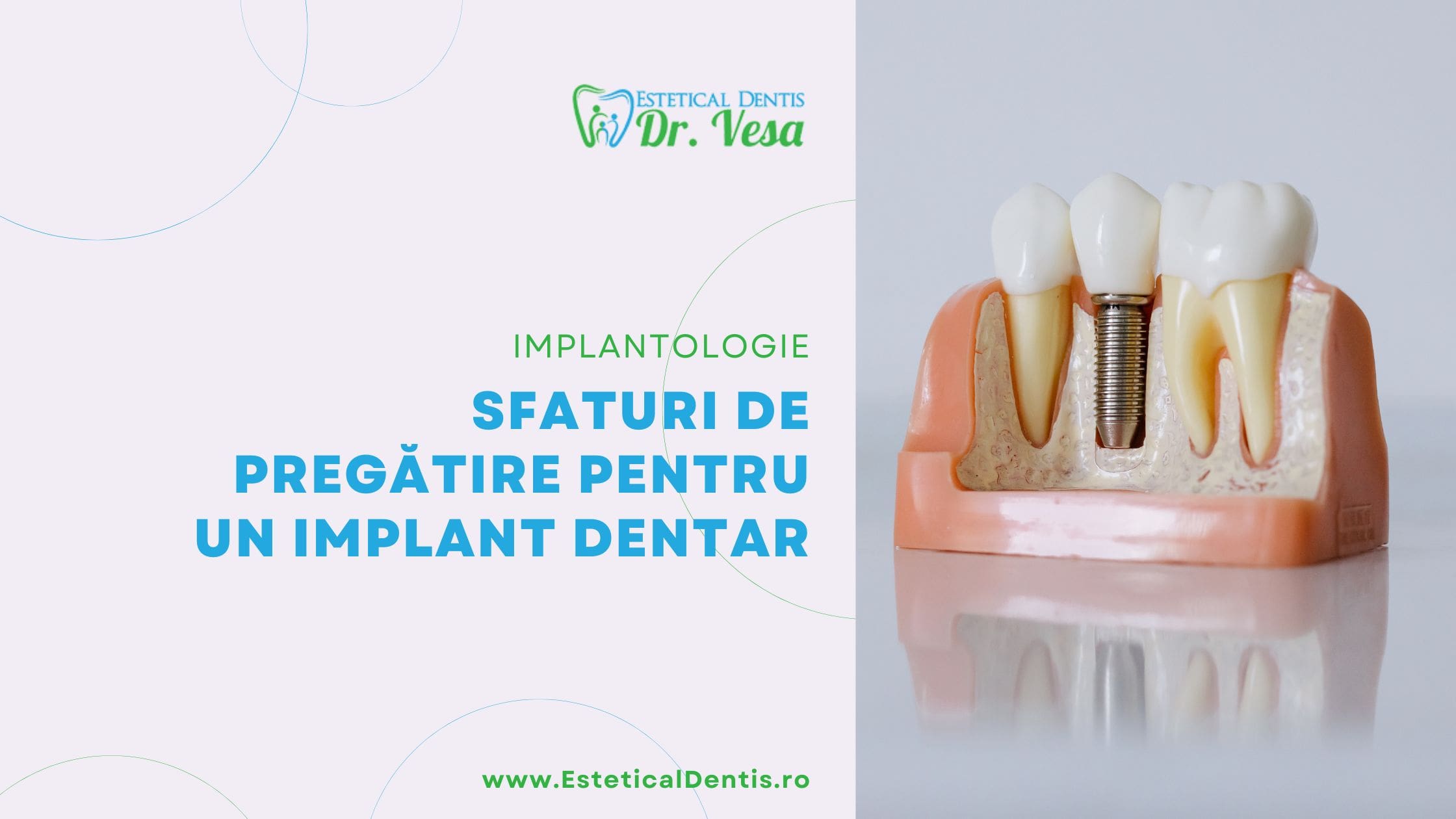 Sfaturi de pregatire pentru un implant dentar