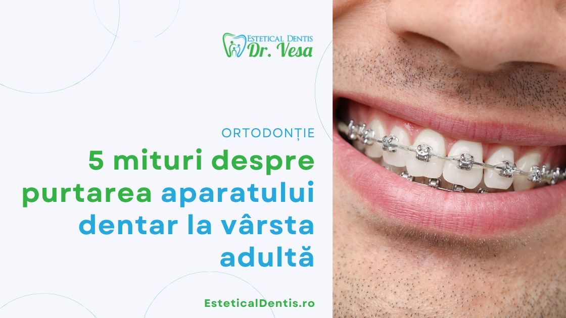 5 mituri despre purtarea aparatului dentar la vârsta adultă