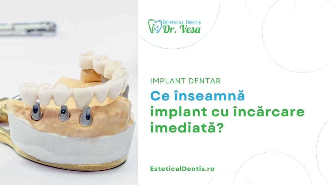 Ce înseamnă implant cu încărcare imediată