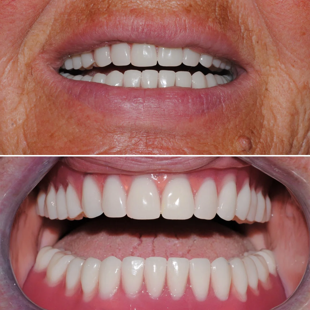 proteza pe implanturi Oradea dupa