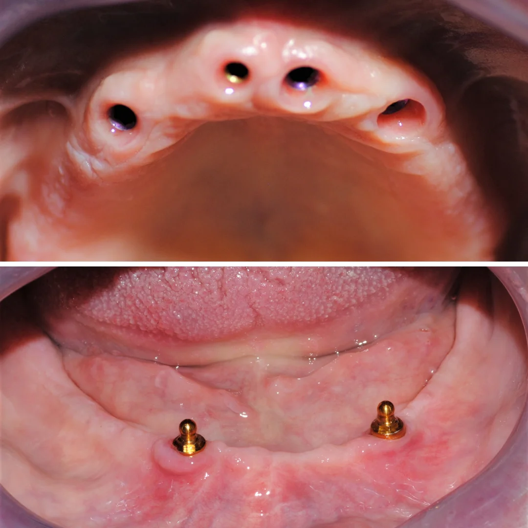 proteza pe implanturi Oradea inainte